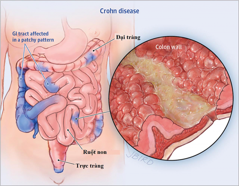 Bệnh viêm ruột từng vùng (Crohn)