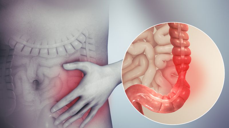 Hội chứng ruột kích thích (IBS) Hội chứng ruột kích thích (IBS)