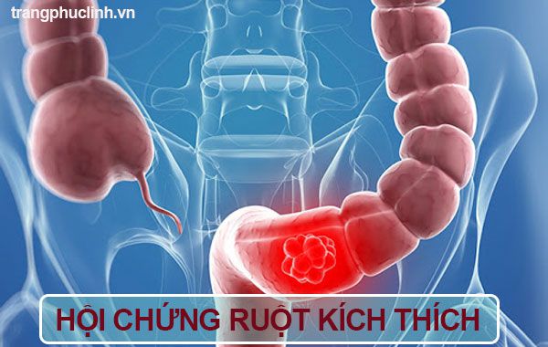 Hội chứng ruột kích thích (IBS) Hội chứng ruột kích thích (IBS)