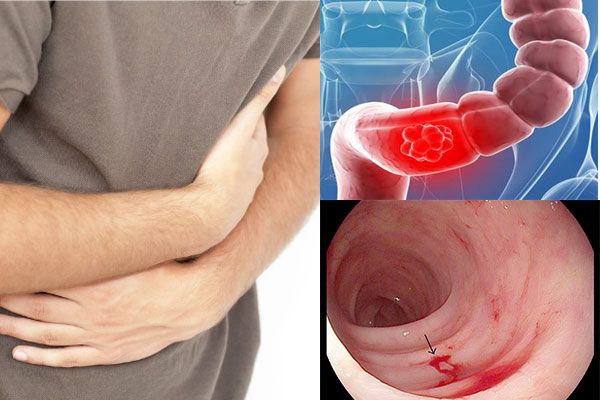 Viêm loét đại tràng (Bệnh UC) Viêm loét đại tràng (Bệnh UC)