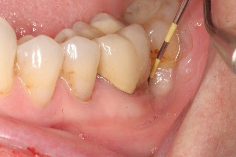Mô quanh răng bị ảnh hưởng