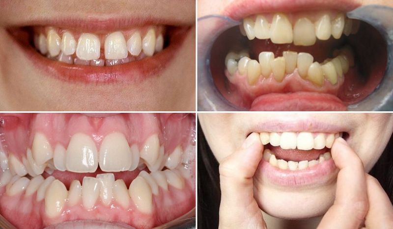 Những trường hợp nên niềng răng trong suốt invisalign
