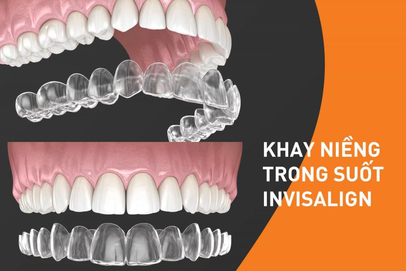 Niềng răng trong suốt Invisalign giá bao nhiêu?