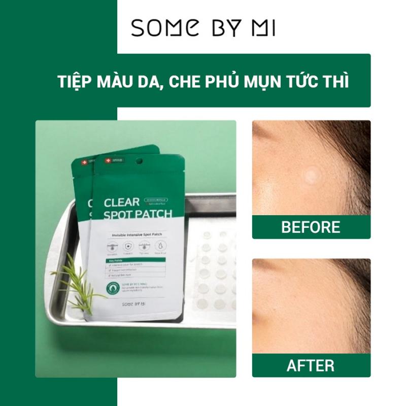 Miếng dán mụn Some By Mi Don't Pop It Just Leave It 18Pcs Miếng dán mụn Some By Mi Don't Pop It Just Leave It 18Pcs