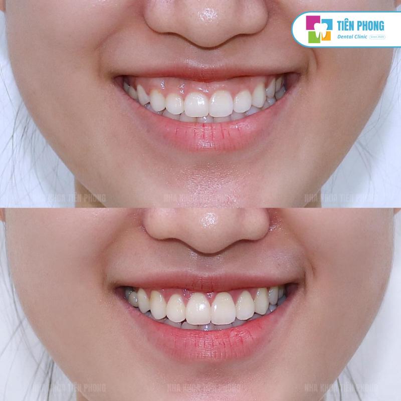 Nha Khoa Tiên Phong