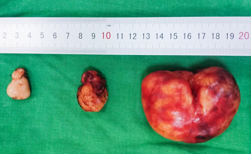 Điều trị u xơ tử cung như thế nào?