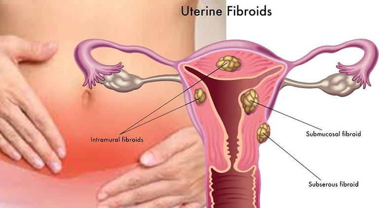 U xơ tử cung là gì?