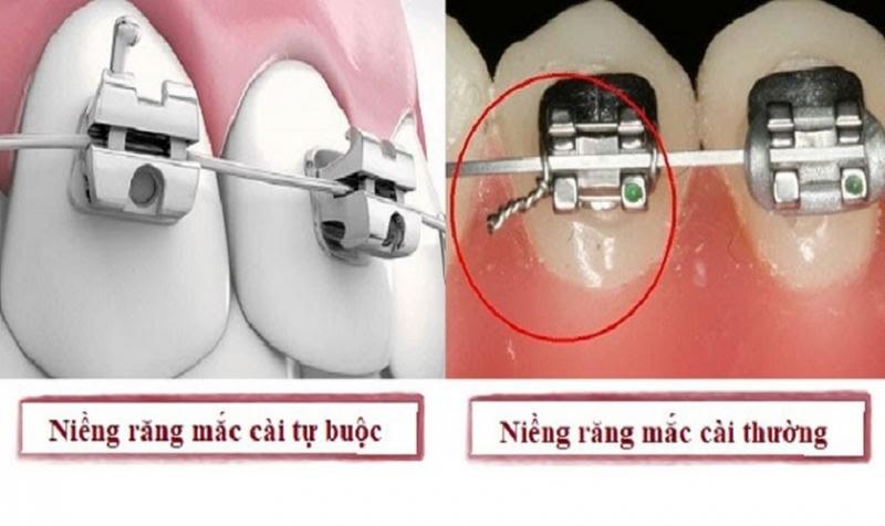 Các loại niềng răng bằng vật liệu 3M